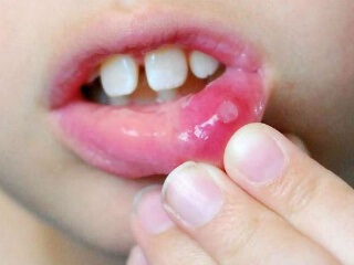 Használati utasítást hlorofillipt gyermekek és felnőttek számára a torok és más betegségek
