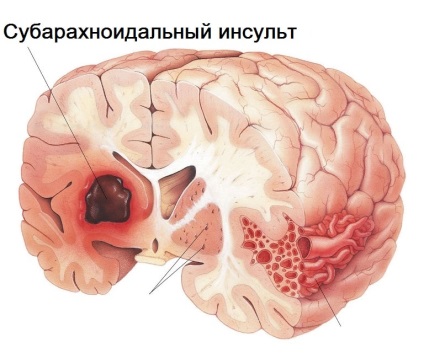 Stroke és annak következményei az élet után a „kudarc”