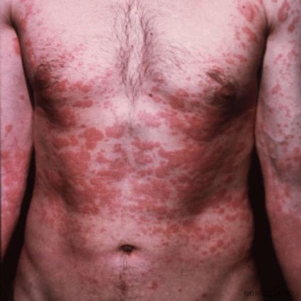 Meddig tart allergiás bőrkiütés, csalánkiütés a felnőttek és gyermekek