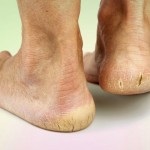 lábduzzadás okok és hogyan lehet megszabadulni a láb duzzanata
