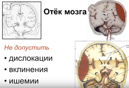 Duzzanat az agy a stroke prognózisa, a tünetek (előrejelzés) Duzzanat az agy a stroke prognózisa, a tünetek