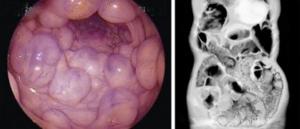 bél pneumatosis okoz, tünetek és kezelés