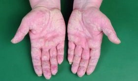 Psoriasis a könyök kezelés, a tünetek, okok, fotó