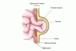 Köldöksérv csecsemők - kezelés otthon alatt kötszer, tapasz, masszázs