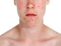 Kiütések a homlok felnőtt akne okoz, kezelés