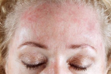 Kiütések a homlok felnőtt akne okoz, kezelés