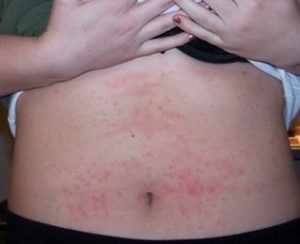 Allergiás bőrkiütés a hasán, nincs viszketés és viszketés, okai