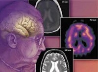Vaszkuláris demencia - okai, tünetei, diagnózisa és kezelése