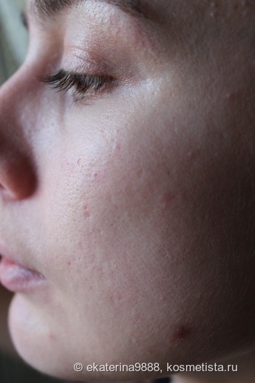 100% természetes gél - peeling savak analóg válaszok (tömegpiaci Cosmetics) 100% -ban természetes gél - peeling vannak az analóg savak értékelés