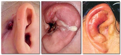 Tályog külső fül tüneteket, típusok, kezelésére és megelőzésére betegségek