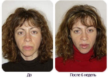 Aerobic a bőr és az izmok az arc (aerobik) Aerobic a bőr és az izmok az arc