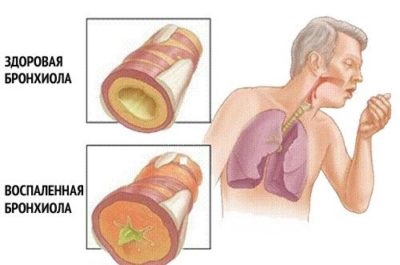 Allergiás bronchitis tünetei és kezelése felnőttek és gyermekek