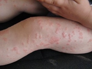 Allergia folsav - tünetek és kezelés