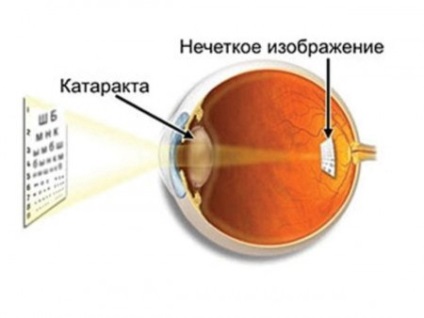 Amblyopia szemében mi ez, és hogyan kell kezelni azt