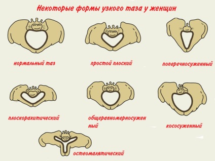 Anatómiailag és klinikailag szűk medence - hogyan kell meghatározni a méretét a szülészeti, sürgősségi ellátás, 1-2