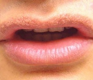 Fehér ajkak pont -, hogyan lehet megszabadulni a kis kiütések az ajkakon