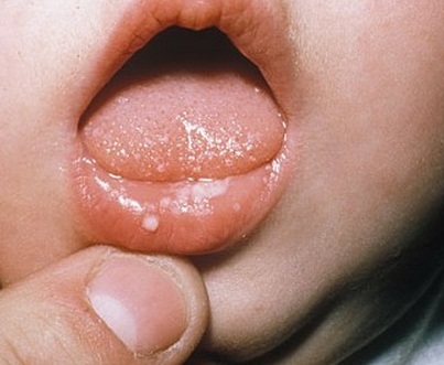 Fehér ajkak pont -, hogyan lehet megszabadulni a kis kiütések az ajkakon