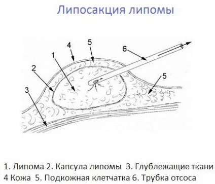 Білі жировики на обличчі як позбутися, видалити, причини