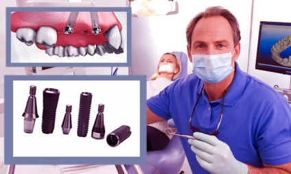 Nem sebészeti implantátumok - tökéletes helyreállítása a fogak (implantátumok) Nem sebészeti implantátumok - a legjobb megoldás fogpótlások