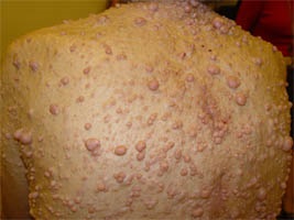 Recklinghausen-kór okai, tünetei, kezelése (neurofibromatózis) Recklinghausen-kór okai, tünetei, a kezelés
