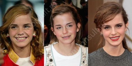 Braces csillagok és hírességek, fotók előtt és után (zárójelben csillag) Braces csillagok és hírességek, fotók előtt és után
