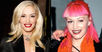 Braces csillagok és hírességek, fotók előtt és után (a csillagok) Braces csillagok és hírességek, fotók előtt és után