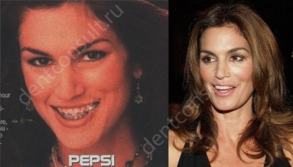 Braces csillagok és hírességek, képek előtt és után (fotó) Braces csillagok és hírességek, fotók előtt és után