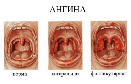 Mi a különbség az angina mandulagyulladás, hogyan lehet megkülönböztetni a különbséget, fotó, akut, krónikus