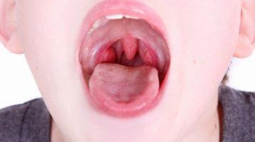 Mi a különbség az angina mandulagyulladás, hogyan lehet megkülönböztetni a különbséget, fotó, akut, krónikus (angina) Mi a különbség az angina mandulagyulladás, hogyan lehet megkülönböztetni a különbséget, fotó, akut, krónikus