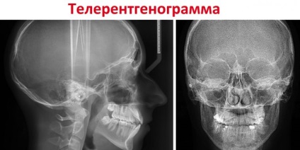 Mi teleroentgenography (trg), és hogy feltárja telerentgenogramma (telerentgenogramma) Mi teleroentgenography (trg), és hogy feltárja telerentgenogramma