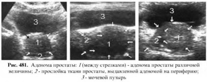 Diagnózis a prosztata betegségek (diagnosztikája prosztata betegségek) Diagnózisa prosztata betegségek