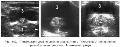 Diagnosztizálása prosztata betegségek (betegségek) Diagnózisa prosztata betegségek