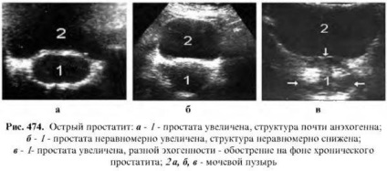 Diagnosztizálása prosztata betegségek (betegségek) Diagnózisa prosztata betegségek