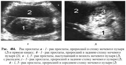 Diagnózis a prosztata betegségek (diagnosztika) Diagnózisa prosztata betegségek