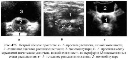 Diagnózis a prosztata betegségek (magasabb echogenicitást) Diagnózisa prosztata betegségek