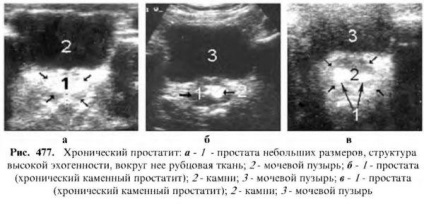 Diagnosztizálása prosztata betegségek (betegségek) Diagnózisa prosztata betegségek
