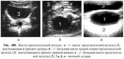 Diagnózis a prosztata betegségek (diagnosztika) Diagnózisa prosztata betegségek