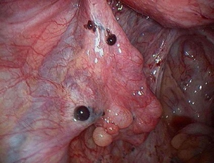 Diffúz méh endometriosis