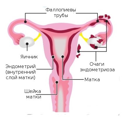 Diffúz méh endometriosis