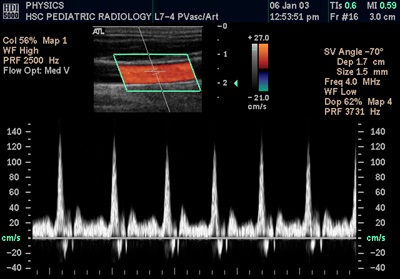 Doppler ultrahang a magzat, amely (Doppler ultrahang a magzat)