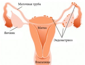 endometriózis annak okait, tünetei, diagnózisa, kezelése