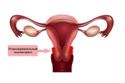 Az endometriózis méh tünetek és a kezelés