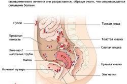 Az endometriózis méh tünetek és a kezelés