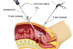 Az endometriózis méh tünetek és a kezelés