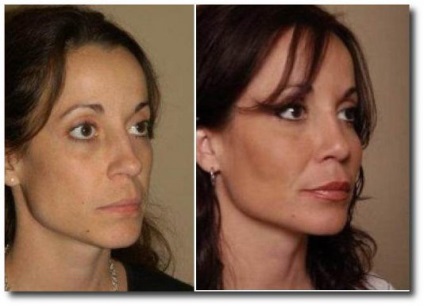 Töltőanyagok a arccsont kijavítani ovális arc fotó előtt és után, hialuronsav