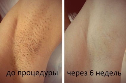 Fotoszörtel véleménye, képek előtt és után (epilálás) Fotoszörtel véleménye, fotók előtt és után