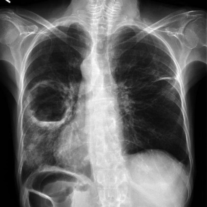 A gangréna pulmonális tünetek, okoz, kezelés (ek) számára A gangréna tüdő tünetei, okoz, a kezelés
