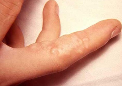 Herpes kézen tünetek és a kezelés az ujjak között otthon