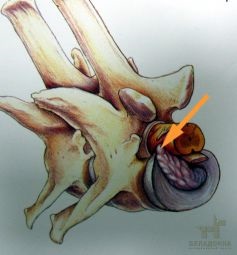 Sérv a kutya porckorong sérv, porckorong sérv (hernia) Sérv a kutya porckorong sérv, porckorong sérv