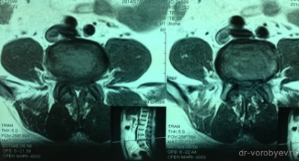 Az implantátumok az ágyéki gerinc, idegsebészet